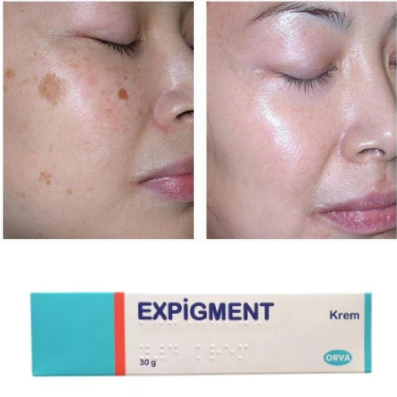 Expigment инструкция на русском языке. Турецкий отбеливающий крем expigment. Экспигмент крем до и после. Турецкий крем от пигментных пятен.